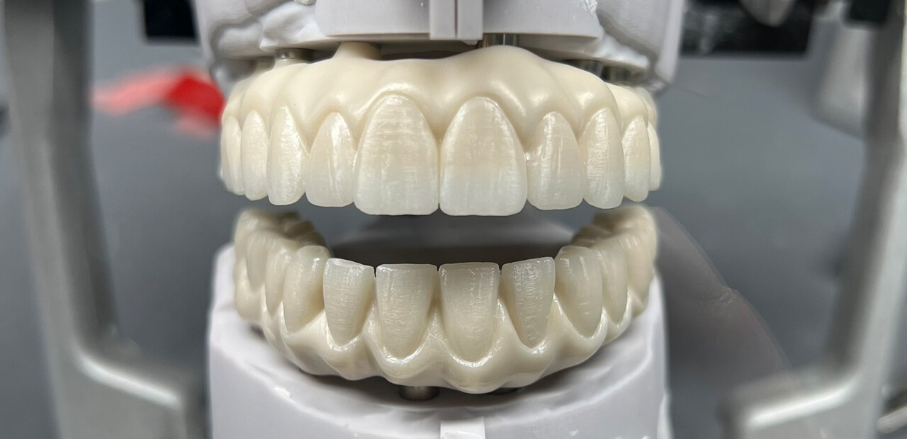 all-on-4-zirconia