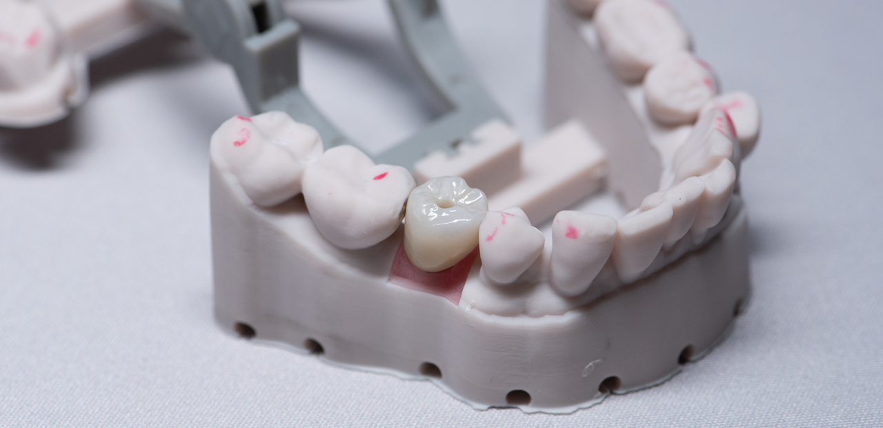 crown_on_implant