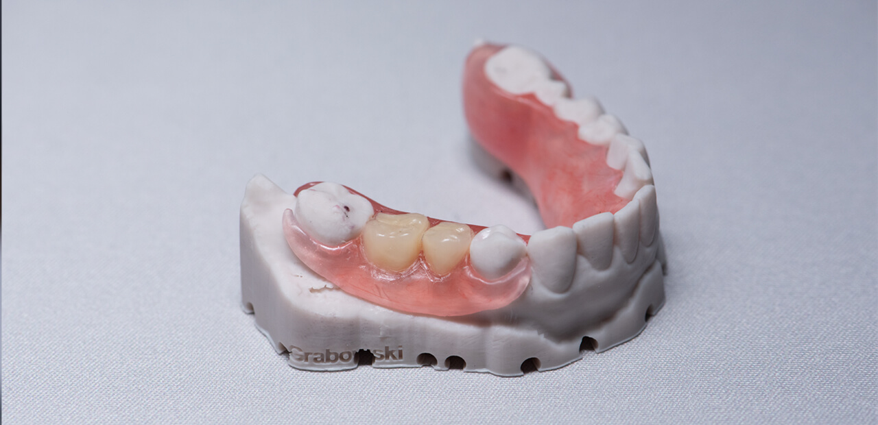 partial_denture_on_printed_model
