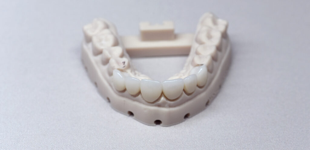 Anterior crowns
