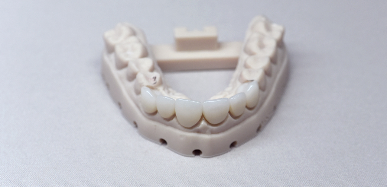 Anterior crowns