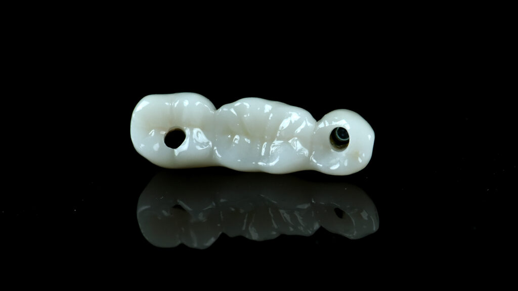 Zirconia bridge on implants