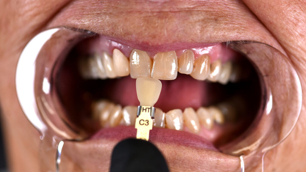 Custom shade of anterior teeth